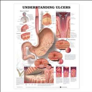  Understanding Ulcers Anatomical Chart 20 X 26 Laminated 